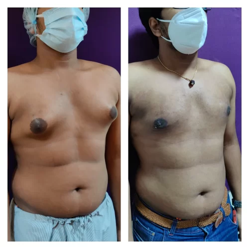 Gynecomastia Surgery 12