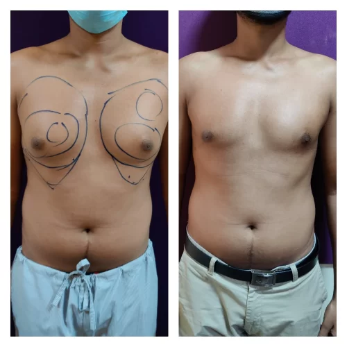 Gynecomastia Surgery 10