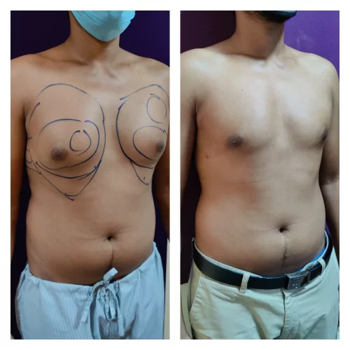 Gynecomastia Surgery 11