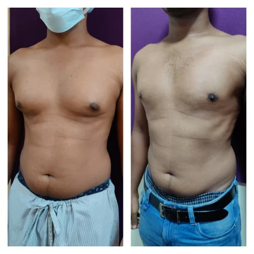 Gynecomastia Surgery 8