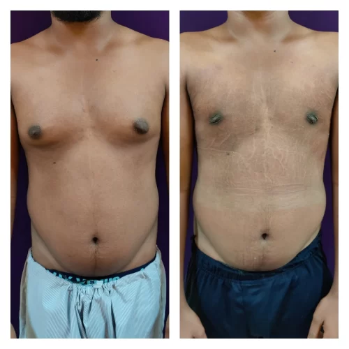 Gynecomastia Surgery 9