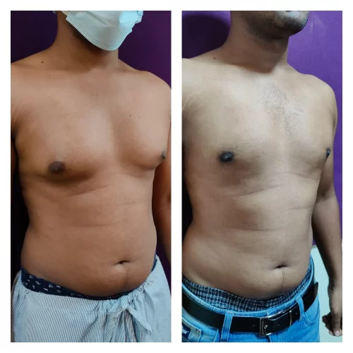 Gynecomastia Surgery 7