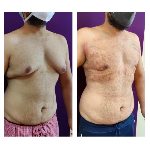 Gynecomastia Surgery results at Venkat Center, Bangalore