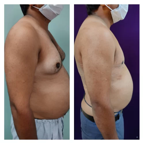 Gynecomastia Surgery results at Venkat Center, Bangalore