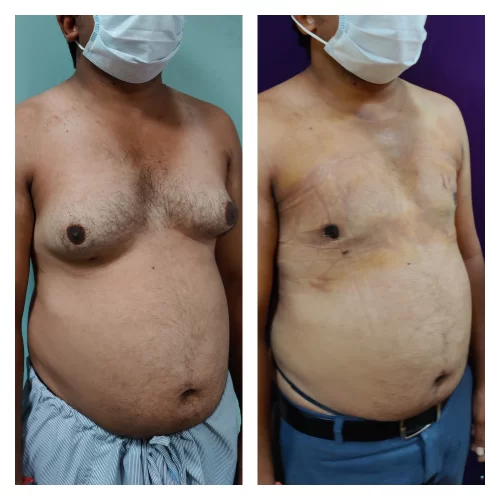 Gynecomastia Surgery results at Venkat Center, Bangalore