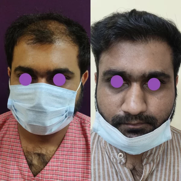 Hair Transplant results at Venkat Center, Bangalore