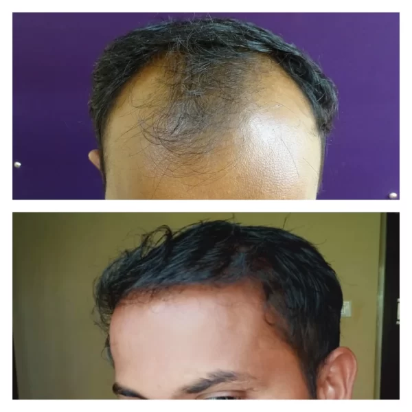 Hair Transplant results - at Venkat Center, Bangalore