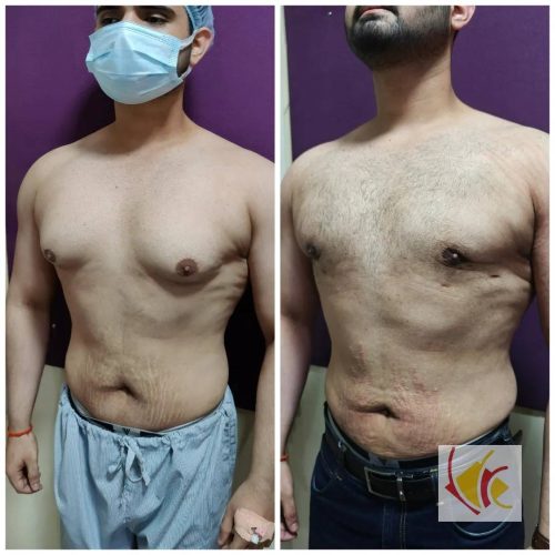 Gynecomastia Surgery 15