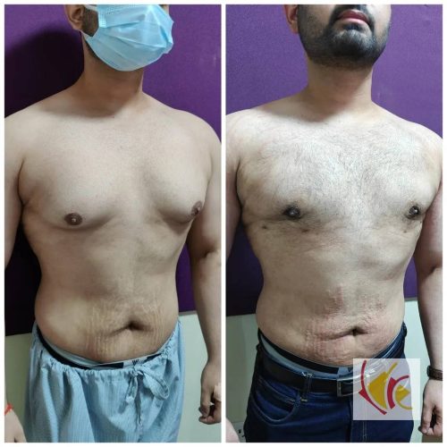 Gynecomastia Surgery 16