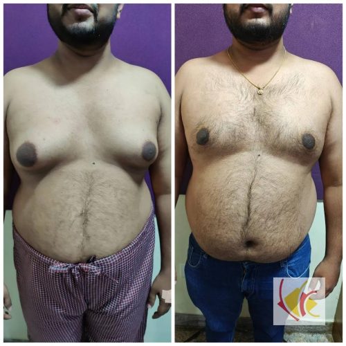 Gynecomastia Surgery 1