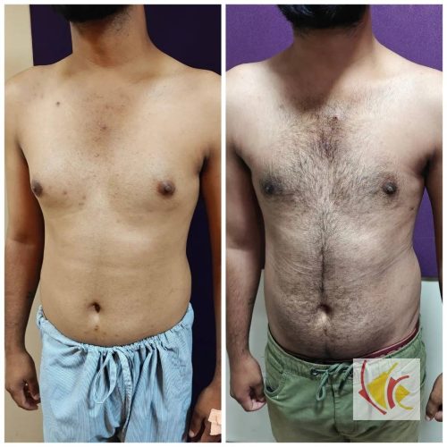 Gynecomastia Surgery 14