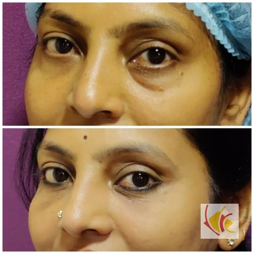 Ageing Eyelid Surgery Blepharoplasty Cost 8