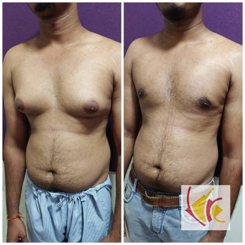 Gynecomastia Surgery 21