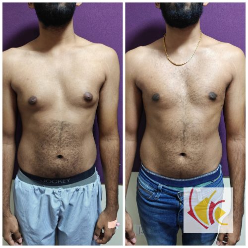 Gynecomastia Surgery 17