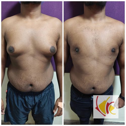 Gynecomastia Surgery 20