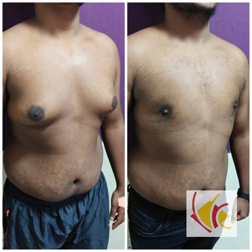 Gynecomastia Surgery 19