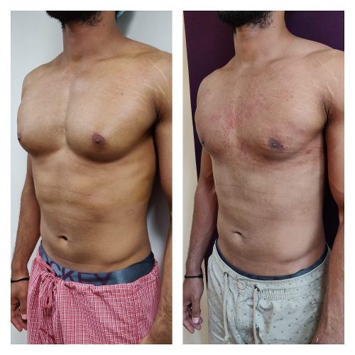 Gynaecomastia Treatment at Venkat Center