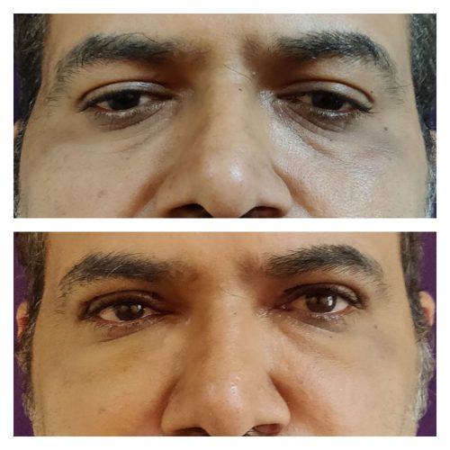 Ageing Eyelid Surgery Blepharoplasty Cost 3