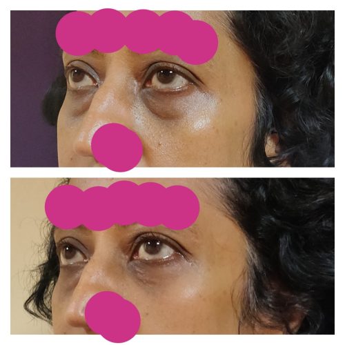 Ageing Eyelid Surgery Blepharoplasty Cost 4