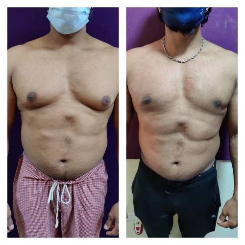 Gynecomastia treatment at Venkat Center, Bangalore