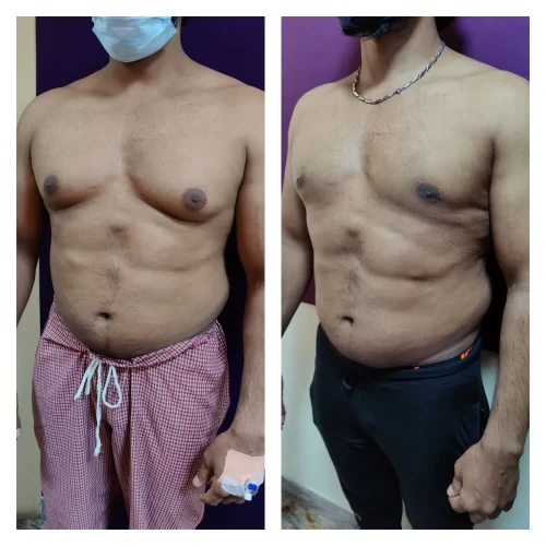 Gynecomastia treatment at Venkat Center, Bangalore