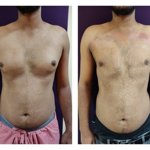 gynecomastia surgery cost in bangalore