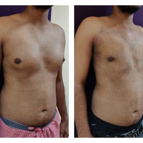 Gynaecomastia Treatment at Venkat Center