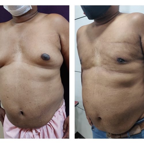 Gynecomastia treatment at Venkat Center, Bangalore