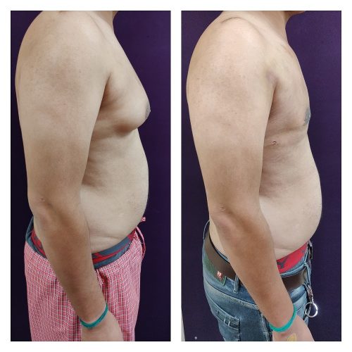 Gynecomastia treatment at Venkat Center, Bangalore