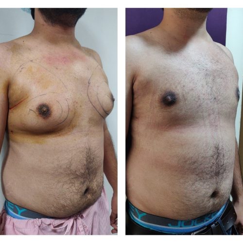 Gynaecomastia Treatment at Venkat Center