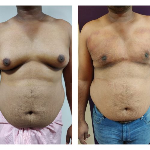 Gynaecomastia Treatment at Venkat Center