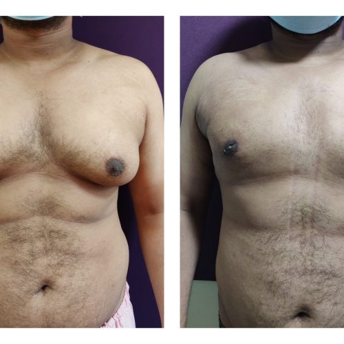 Gynecomastia treatment at Venkat Center, Bangalore