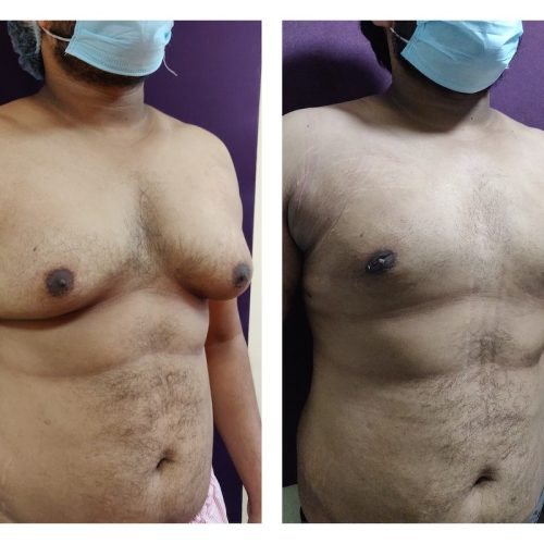 Gynecomastia treatment at Venkat Center, Bangalore